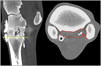 Computed tomographic arthrography, gross anatomy and histology demonstrate a communication between synovial invaginations in the proximal aspect of the third interosseous muscle and the carpometacarpal joint in horses